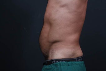 Athletic male who benefited from endoscopic lower abdominal wall tightening. before 659800