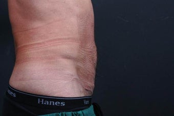 Athletic male who benefited from endoscopic lower abdominal wall tightening. 659800