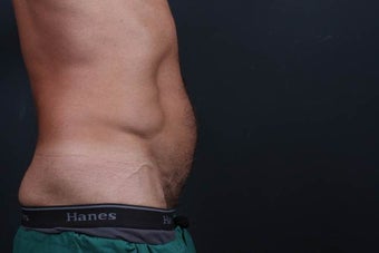 Athletic male who benefited from endoscopic lower abdominal wall tightening. 659800