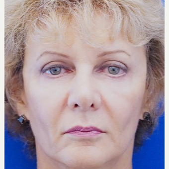 55-64 year old woman treated with Eyelid Surgery after 3678743