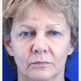 55-64 year old woman treated with Eyelid Surgery before 3678743