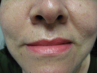 A 50 year old female before and after mole removal on the face after 1186864