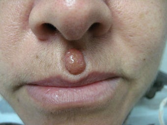 A 50 year old female before and after mole removal on the face before 1186864