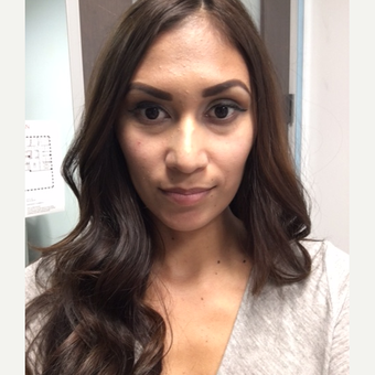 25-34 year old woman treated with Restylane before 2297305