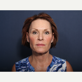 55-64 year old woman treated with Neck Lift (view 1 of 2) before 3709532