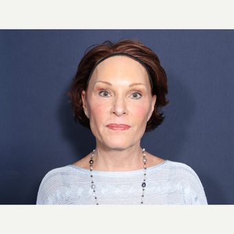 55-64 year old woman treated with Neck Lift (view 1 of 2) after 3709532