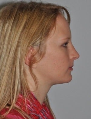 Cosmetic Chin Surgery after 1585901