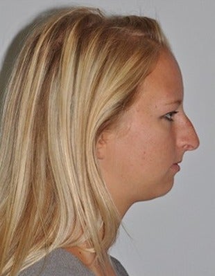 Cosmetic Chin Surgery before 1585901