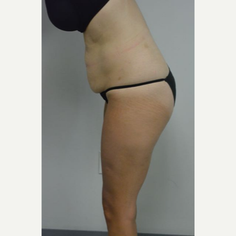 35-44 year old woman treated with Tummy Tuck and liposuction of her flanks and lower back before 3459010