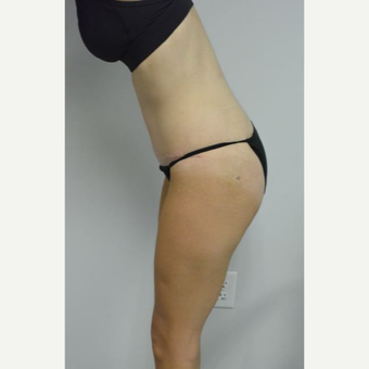 35-44 year old woman treated with Tummy Tuck and liposuction of her flanks and lower back after 3459010