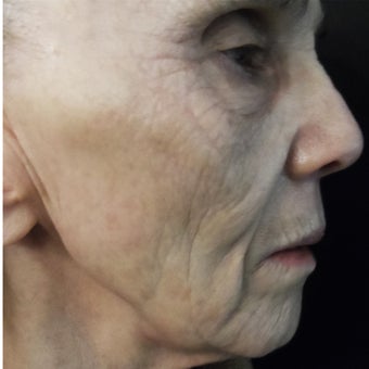 74 year old woman treated with medical micro-needling using human growth factor serums after 1611360