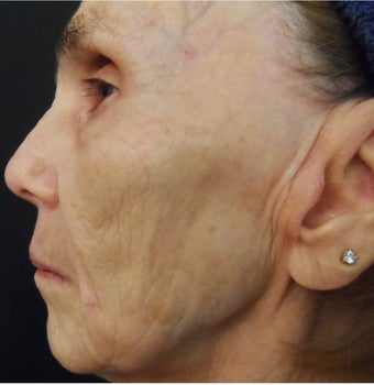 74 year old woman treated with medical micro-needling using human growth factor serums 1611360