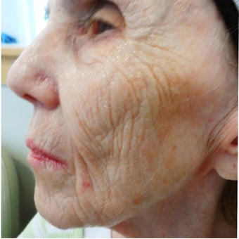 74 year old woman treated with medical micro-needling using human growth factor serums 1611360