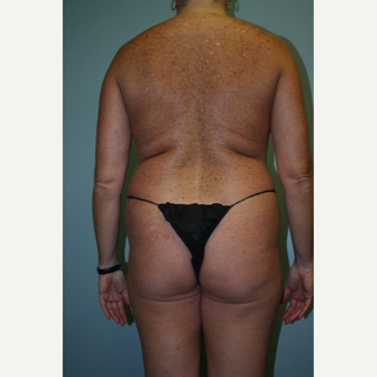 35-44 year old woman treated with Brazilian Butt Lift before 3338632