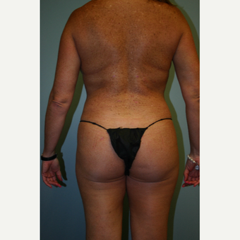 35-44 year old woman treated with Brazilian Butt Lift after 3338632