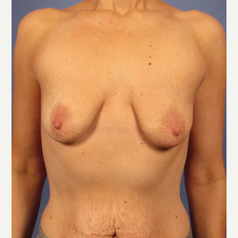 25-34 year old woman treated with Breast Augmentation before 3106670