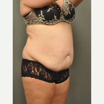 35-44 year old woman treated with Tummy Tuck before 2520141