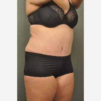 35-44 year old woman treated with Tummy Tuck after 2520141