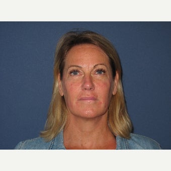45-54 year old woman treated with Bellafill before 2622362