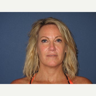 45-54 year old woman treated with Bellafill after 2622362