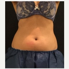 25-34 year old woman treated with CoolSculpting before 3181751