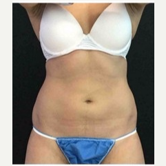 25-34 year old woman treated with CoolSculpting after 3181751