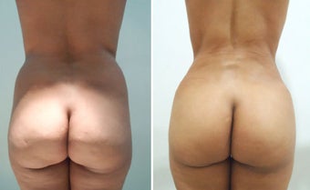 Butt Augmentation before 1087931