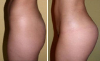 Butt Augmentation after 1087931