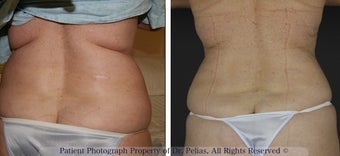 V-Shape skin tightening before 1250130