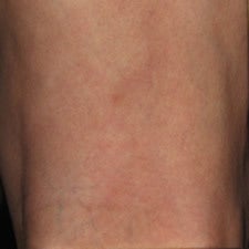 Patient treated with sclerotherapy for small varicose veins / reticular veins of the back of the leg after 914989