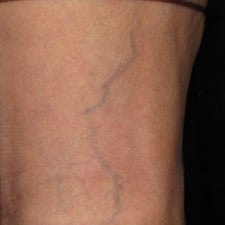 Patient treated with sclerotherapy for small varicose veins / reticular veins of the back of the leg before 914989