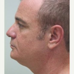 35-44 year old man treated with Smart Lipo before 3243256