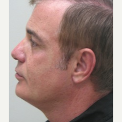35-44 year old man treated with Smart Lipo after 3243256