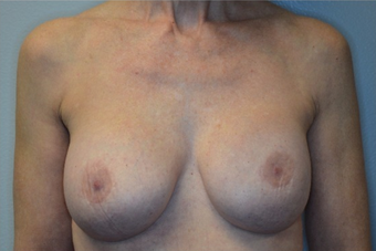 60 year old woman treated with Breast Implant Revision after 2541822