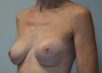 60 year old woman treated with Breast Implant Revision 2541822