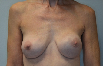 60 year old woman treated with Breast Implant Revision before 2541822
