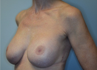 60 year old woman treated with Breast Implant Revision 2541822