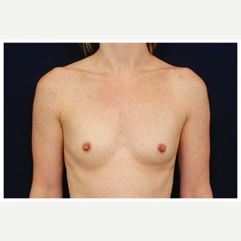 25-34 year old woman treated with Inspira Breast Implants before 1860188