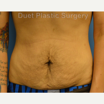 25-34 year old man treated with Male Tummy Tuck before 3368658