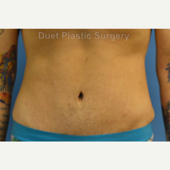25-34 year old man treated with Male Tummy Tuck after 3368658