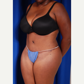 35-44 year old woman treated with Tummy Tuck Revision after 2818418