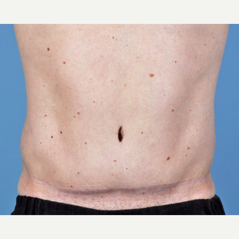 35-44 year old man treated with Tummy Tuck after 3837545
