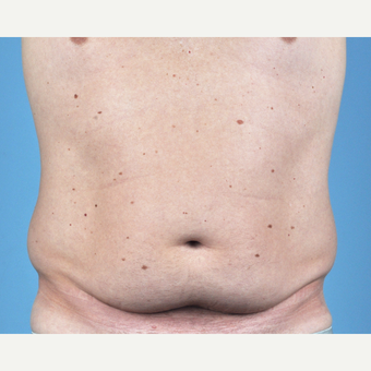 35-44 year old man treated with Tummy Tuck before 3837545