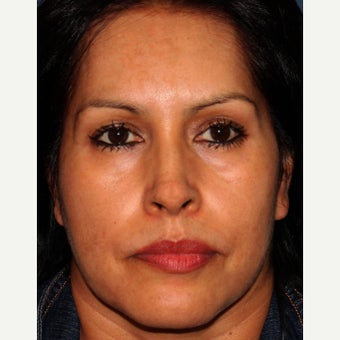 35-44 year old woman treated with Melasma Treatment after 2078631