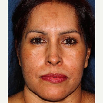 35-44 year old woman treated with Melasma Treatment before 2078631