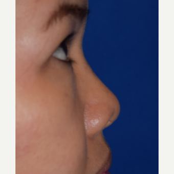25-34 year old woman treated with Non Surgical Nose Job before 3650029