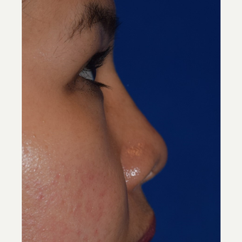 25-34 year old woman treated with Non Surgical Nose Job after 3650029