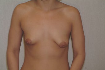 31 year old woman desires correction of small droopy breasts before 1481468