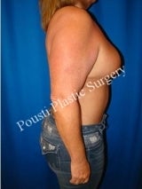 2 Stage Breast Procedure, Breast Implant Removal, Breast Lift, Revision Breast Surgery 1517980