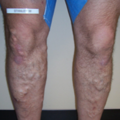 Bilateral VNUS Closures and subsequent Sclerotherapy (Injections) before 1576302
